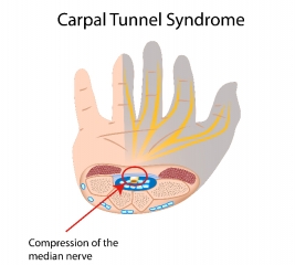 Carpal tunnel syndrome, eps10