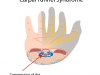 Carpal tunnel syndrome, eps10